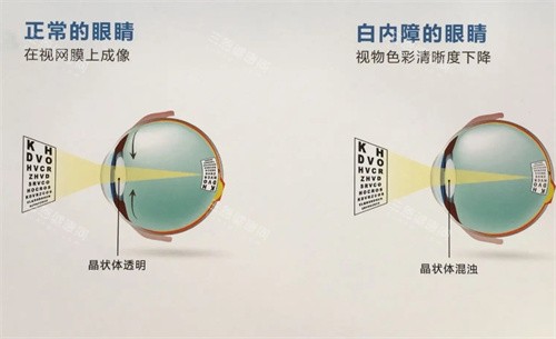 想在广西申请免费白内障手术？这些条件你要知道！