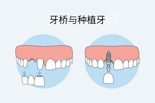 衡阳颗美口腔牙冠桥和种植牙对比图