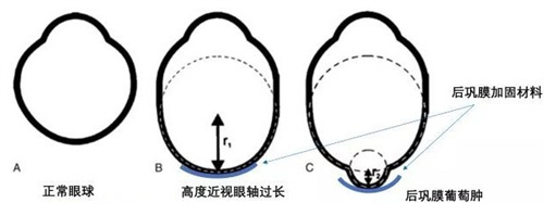 封康后巩膜加固手术成效怎么样?成功例子多,好评也很多,一键预约封康医生