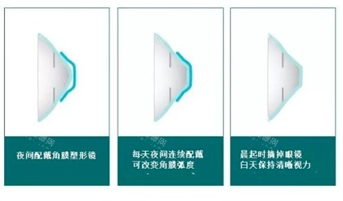 菏泽福仁眼科做角膜塑形镜真不错，近视防控收费不贵更具性价比！