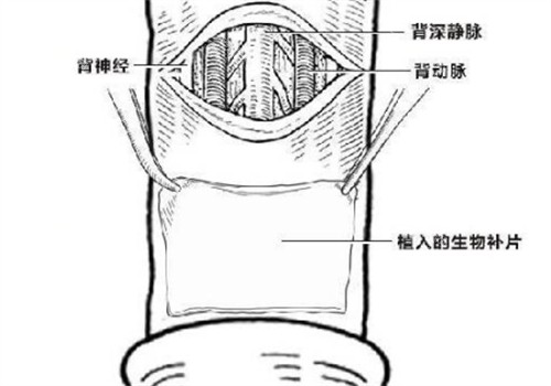 上海九龙男科私密整形：假体三件套技术到底好不好？过来人告诉你真实体验和结果！