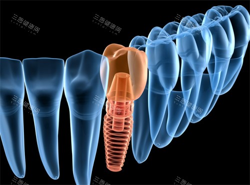 德国bego种植牙靠谱吗？优缺点、价格、使用寿命全分析，看完再决定！