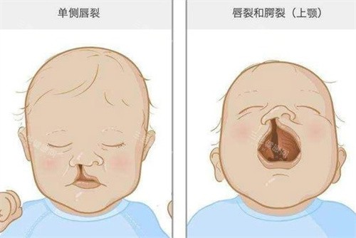 北京哪家医院做唇腭裂手术好?正美整形与画美整形都是做唇腭裂手术好的正规医院