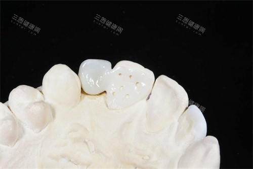 马里兰桥优缺点全解析！一颗牙多少钱？适用范围/美观度/耐用性大比拼！
