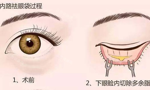 吴承勇做眼袋手术怎么样？从技术手法、术后改善结果来看，吴承勇做眼袋手术很靠谱，技术娴熟