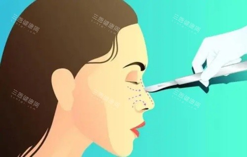 深圳鼻整形医生名单曝光！李信锋黄金三角鼻雕+梁晓健专有技术，自然鼻型实例破万~