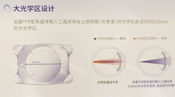 龙晶pr晶体建议买的三个型号解析：前房浅选11.5mm/标准眼选12.8mm/大角膜选14.0mm！你适合哪款？