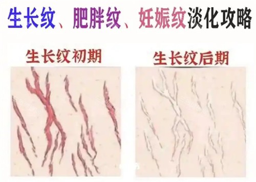 膨胀纹的样子