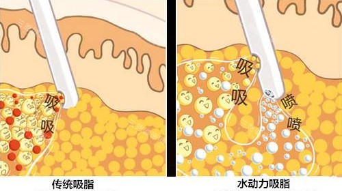 郑州丽天整形正规吗？没错！它是正规私立医美机构，吸脂及吸脂修复技术可靠，罗明生医生口碑佳