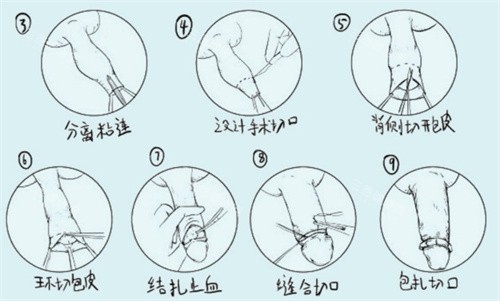 割包皮手术过程
