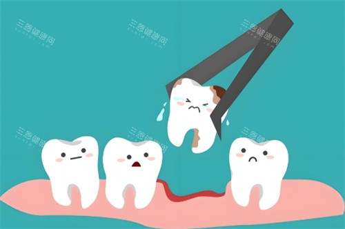 拔牙动画示图