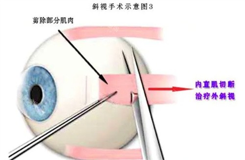 合肥斜视手术哪个医生做的好？封利霞吴章友等口碑医生盘点|附术后成效+费用指南