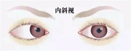 合肥斜视手术排名头一是哪家？五大医院真实测评：维视/华厦/沃瑞等口碑技术谁更强？