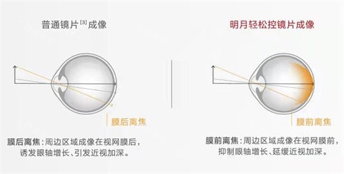 明月轻松控镜片成像