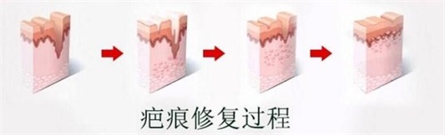 北京八大处祛疤真实反馈：超减张缝合术+肤色匹配线，社交距离无痕修复~