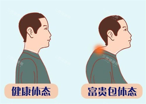 鹰潭做富贵包手术医院哪家好?整友推荐:美嘉整形做富贵包技术口碑都不错!