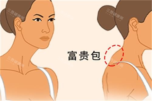 新余治疗富贵包手术价格多少钱?新余富贵包收费价目表完整公布!