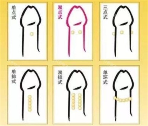 入龙珠到底一圈好还是两圈好？整形医生深度剖析：不同身体这样选才自然！
