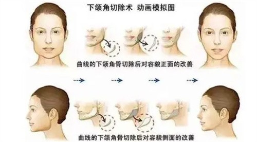 重庆肖林下颌角手术怎么样？一句话：技术好、成效自然、口碑出众，想做下颌角，找他靠谱！