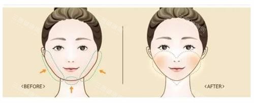 李献和磨骨怎么样？有临床经验近20年、专注于腹壁整形和颌面轮廓、磨骨成功实例大5000例~