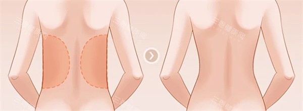 背部吸脂