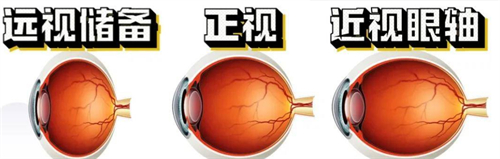 不同眼睛问题的眼轴不同 不同眼睛问题的眼轴不同