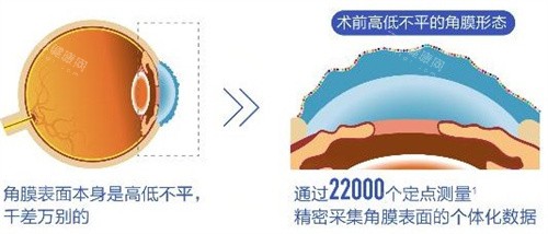 个性化飞秒术前 个性化飞秒术前