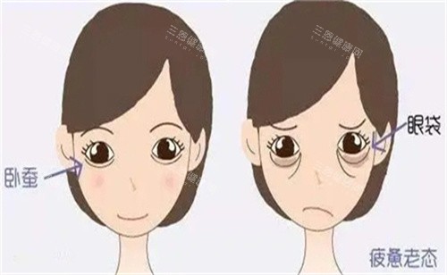 卧蚕手术对比