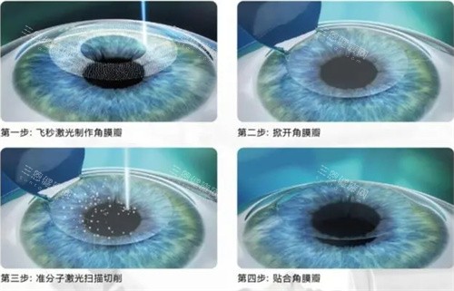 广州看眼科收费价格一览表：全飞秒8800元起，ICL晶体植入2.6万起！
