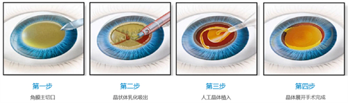 2025重庆白内障手术多少钱？单眼3000元起，这些因素决定具体花费