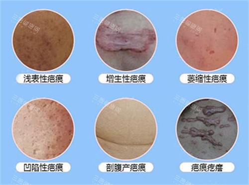 常见的疤痕有哪些