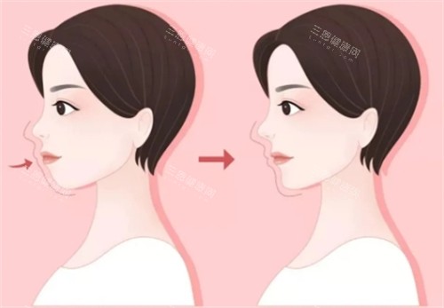 济南正颌手术医院怎么选？这份避坑指南帮你挑对医生，术后脸型对称又自然！