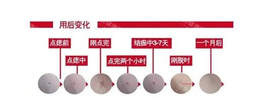 杭州越妍祛斑真实体验：三次激光后雀斑消失，皮肤白皙光滑！