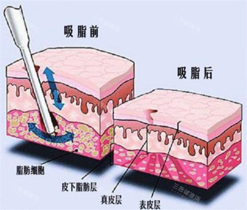 厦门欧菲吸脂怎么样？2025年新价格、技术及真实体验全解析！