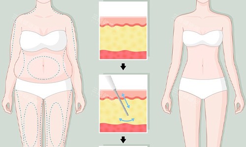 厦门大腿吸脂哪家强？欧菲医疗美容价格、技术优势与真实实例分享！