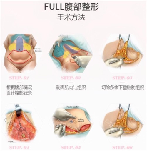 腹壁成形术手术过程图解