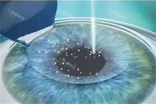 河北省二院飞秒近视费用：全飞秒18800+半飞秒15000+