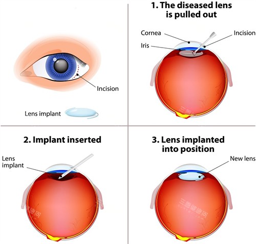晶体植入手术过程