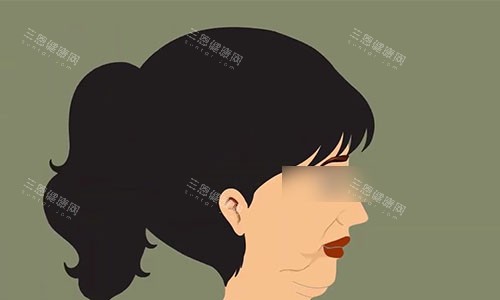 拉皮手术前的动画示意图