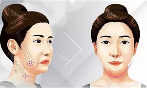 深圳面部拉皮医院排行榜出炉！网红博主实测推荐，这几家技术和医生真的绝了