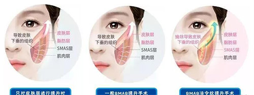 广州VS深圳拉皮手术哪家强？深度对比两地老牌医院，帮你避坑不踩雷！