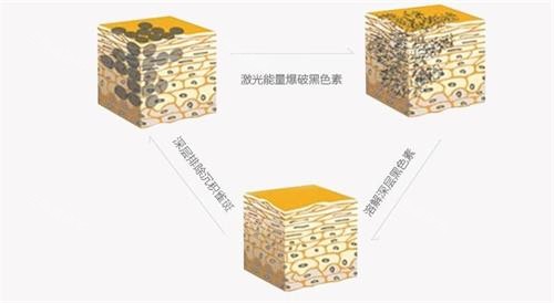 激光和光动力能否一起施展魔法？深入剖析联合治疗的奥秘，给你以前没有的焕肤体验！