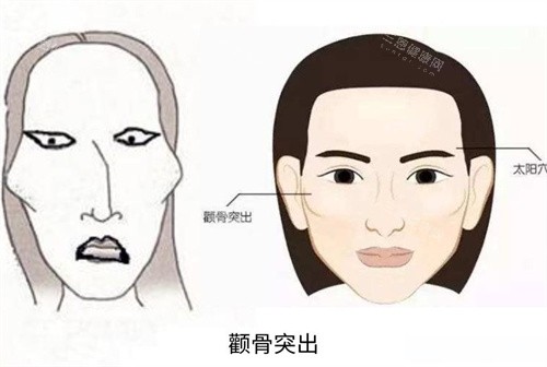 2025四川大学华西医院整形科优惠价格曝光：颧骨内推4.8万起，驼峰鼻矫正2.5万起，大腿吸脂4.2万起