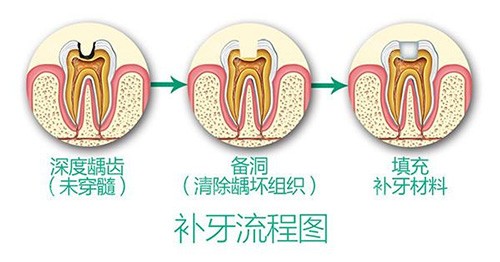 广州侨城口腔补牙可以吗?树脂补牙280元/颗起|3M纳米树脂自然牢固不脱落!