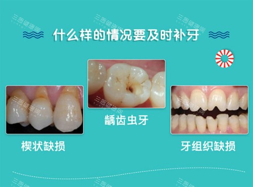 深圳补牙齿一般要多少钱一颗？国产树脂补牙150元起、进口300元起、银汞合金200元起、根管治疗500元起~