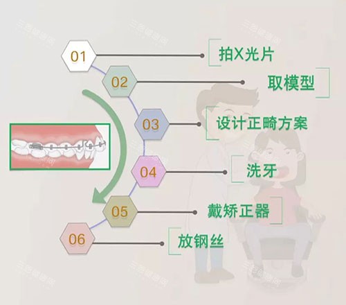 牙齿矫正费用大比拼！隐形矫正VS传统矫正，成年人矫正的更佳年龄是几岁？