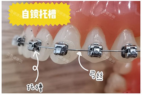 22岁还能做牙齿矫正吗？更佳年龄和费用全解析，隐形矫正价格大公开！