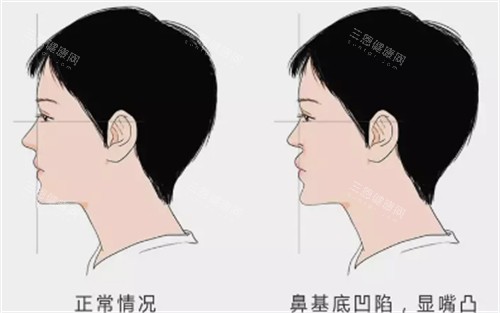 垫鼻基底到底多少钱？从材料到医生技术全方面解析，避免被坑，这份价格指南请收好！