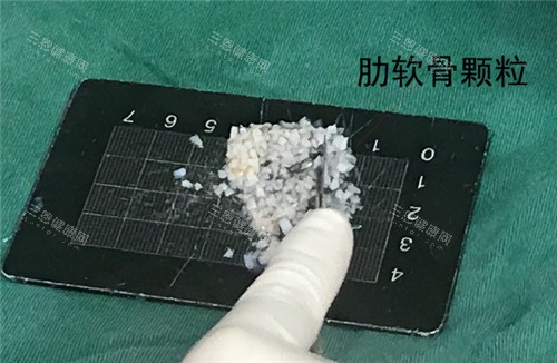 肋骨碎填充鼻基底材料