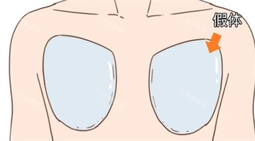 男性隆胸